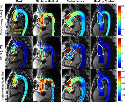 Valvular and ascending aortic hemodynamics of the On-X aortic valved conduit by same-day echocardiography and 4D flow MRI